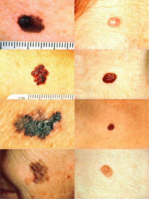 melanoma vs normal mole