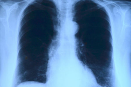 Lung X-Ray